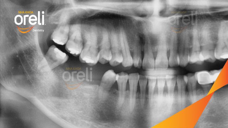 Ca Cấy Ghép Implant Hàm Dưới – Case thực tế tại Oreli