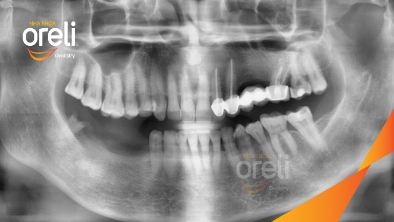 Ca Cấy Ghép Implant Hàm Dưới – Case thực tế tại Oreli