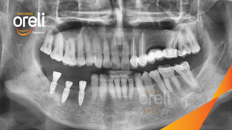 Ca Cấy Ghép Implant Hàm Dưới – Case thực tế tại Oreli