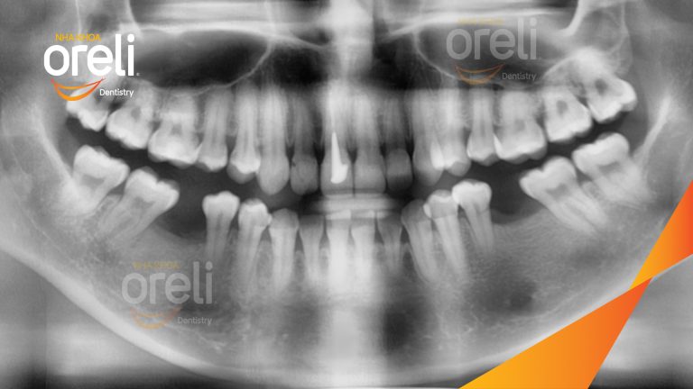Ca Cấy Ghép Implant Phục Hồi Răng Tại Nha Khoa Oreli