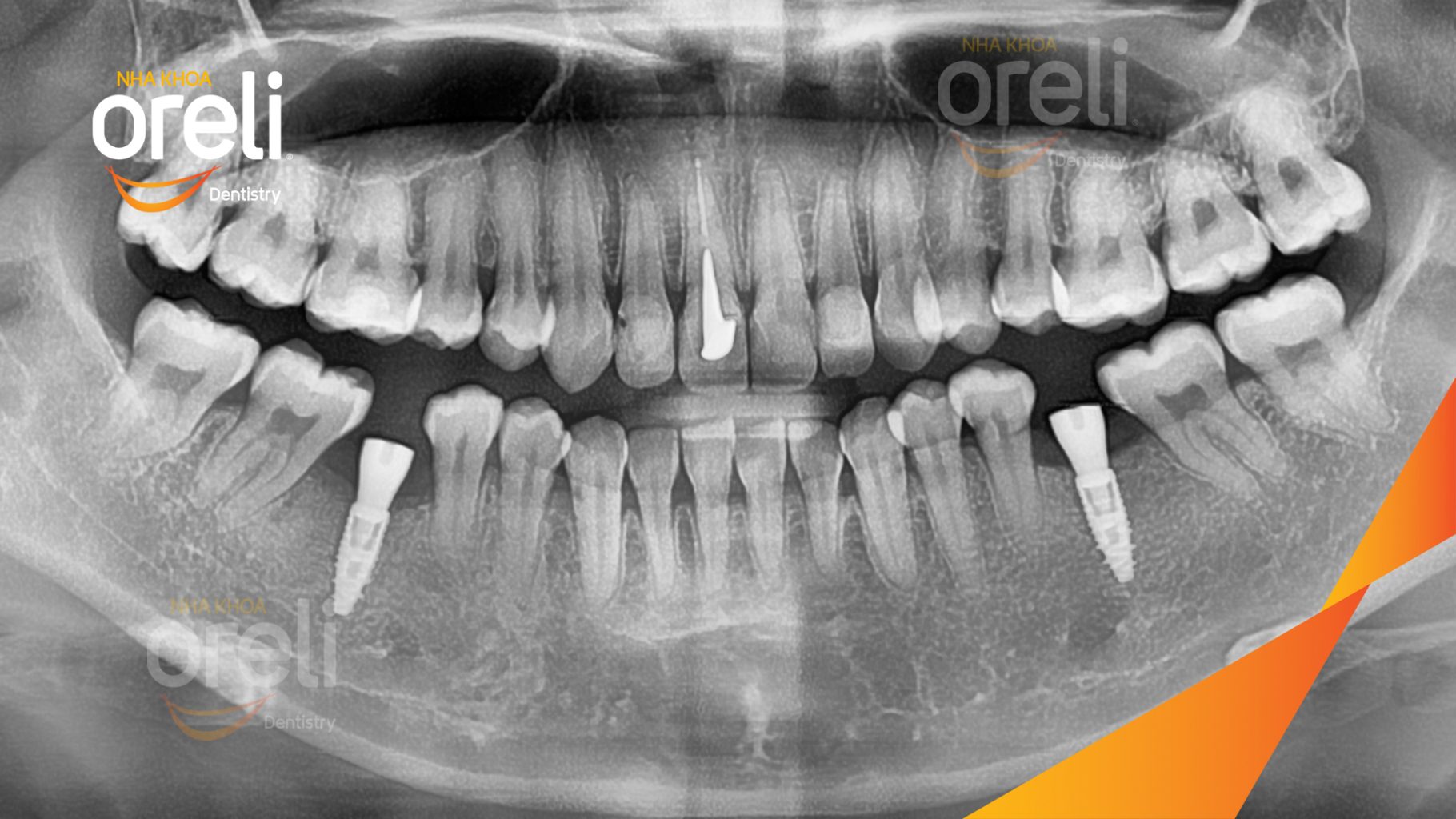 Mất răng hàm dưới trước khi điều trị tại Oreli