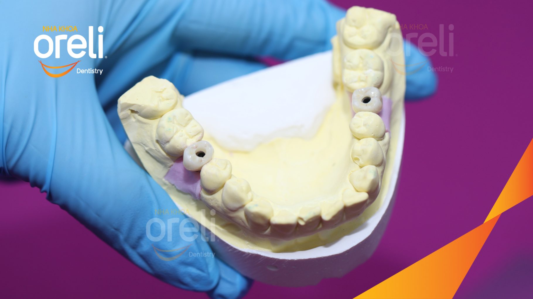 Kết quả sau 3 tháng:  tại Oreli