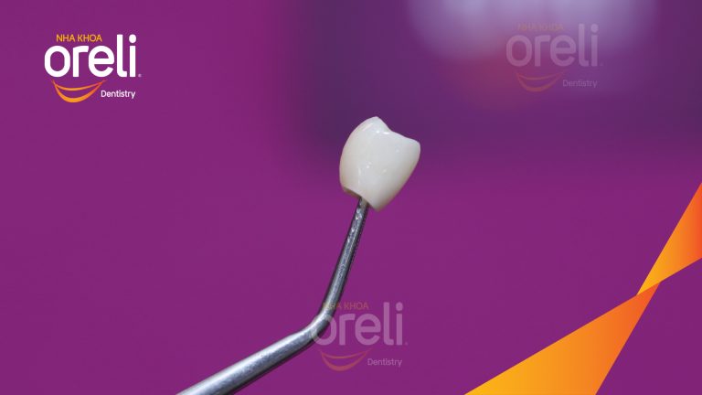 Ca Cấy Ghép Implant Phục Hồi Răng Tại Nha Khoa Oreli