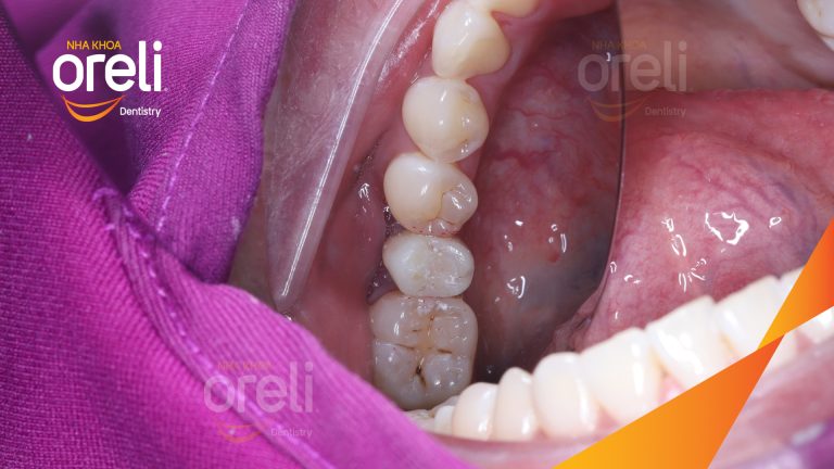 Ca Cấy Ghép Implant Phục Hồi Răng Tại Nha Khoa Oreli