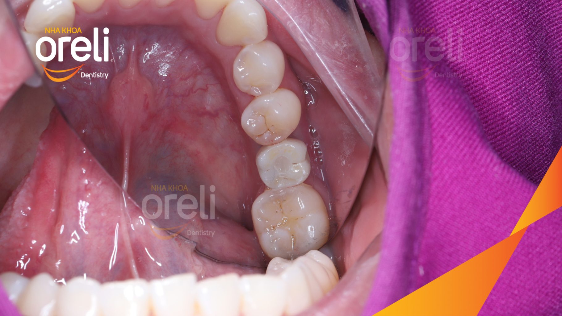 Thực hiện Cấy ghép trụ Implant chính hãng vào vùng mất răng kéo dài 3 tháng tại Oreli