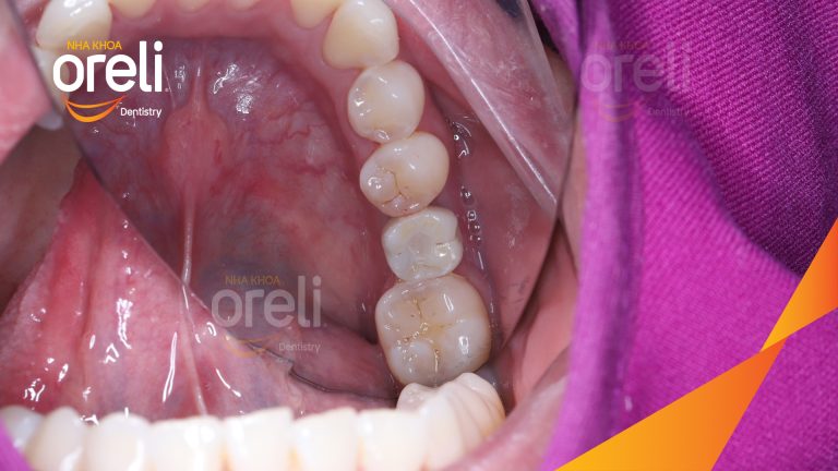 Ca Cấy Ghép Implant Phục Hồi Răng Tại Nha Khoa Oreli