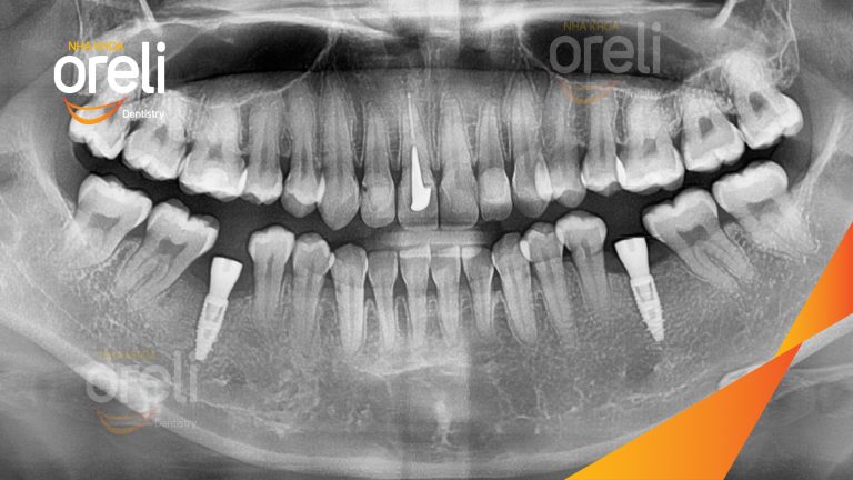 Ca Cấy Ghép Implant Phục Hồi Răng Tại Nha Khoa Oreli