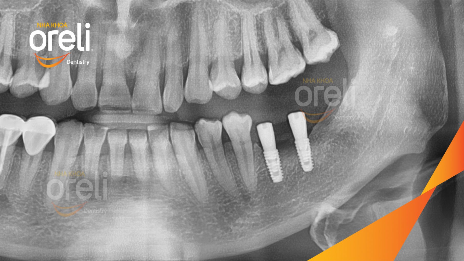Mất răng hàm dưới trước khi điều trị tại Oreli