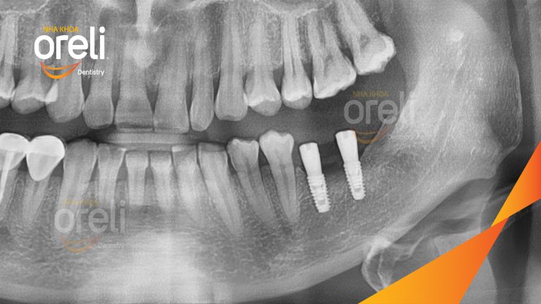 Ca Cấy Ghép Implant Hàm Dưới – Case thực tế tại Oreli