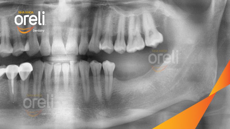 Ca Cấy Ghép Implant Hàm Dưới – Case thực tế tại Oreli
