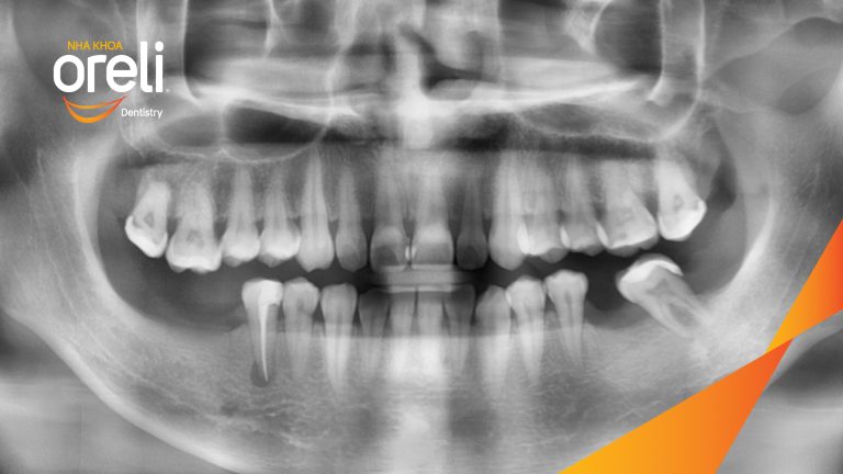 Ca Cấy Ghép Implant Hàm Dưới – Case thực tế tại Oreli