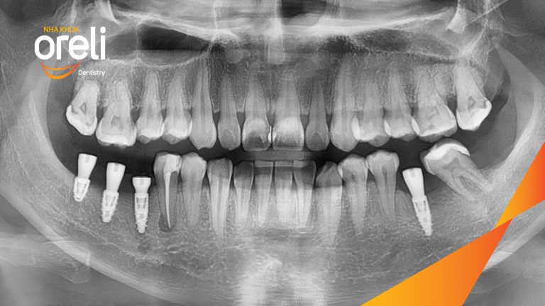 Ca Cấy Ghép Implant Hàm Dưới – Case thực tế tại Oreli