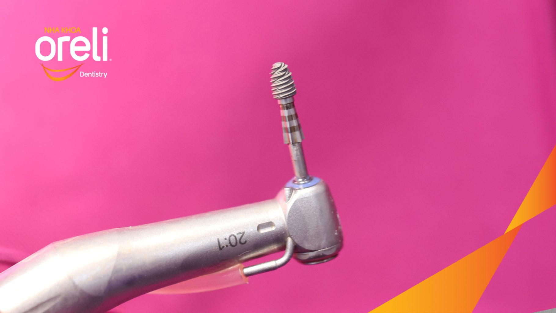 Thực hiện Cấy ghép trụ Implant chính hãng vào vùng mất răng kéo dài 3 tháng tại Oreli