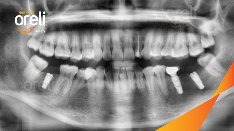 Ca Cấy Ghép Implant Phục Hồi Răng Tại Nha Khoa Oreli