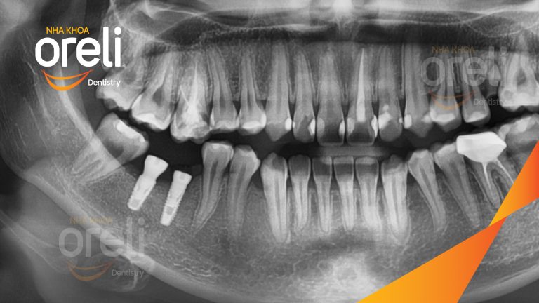 Ca Cấy Ghép Implant Hàm Dưới – Case thực tế tại Oreli