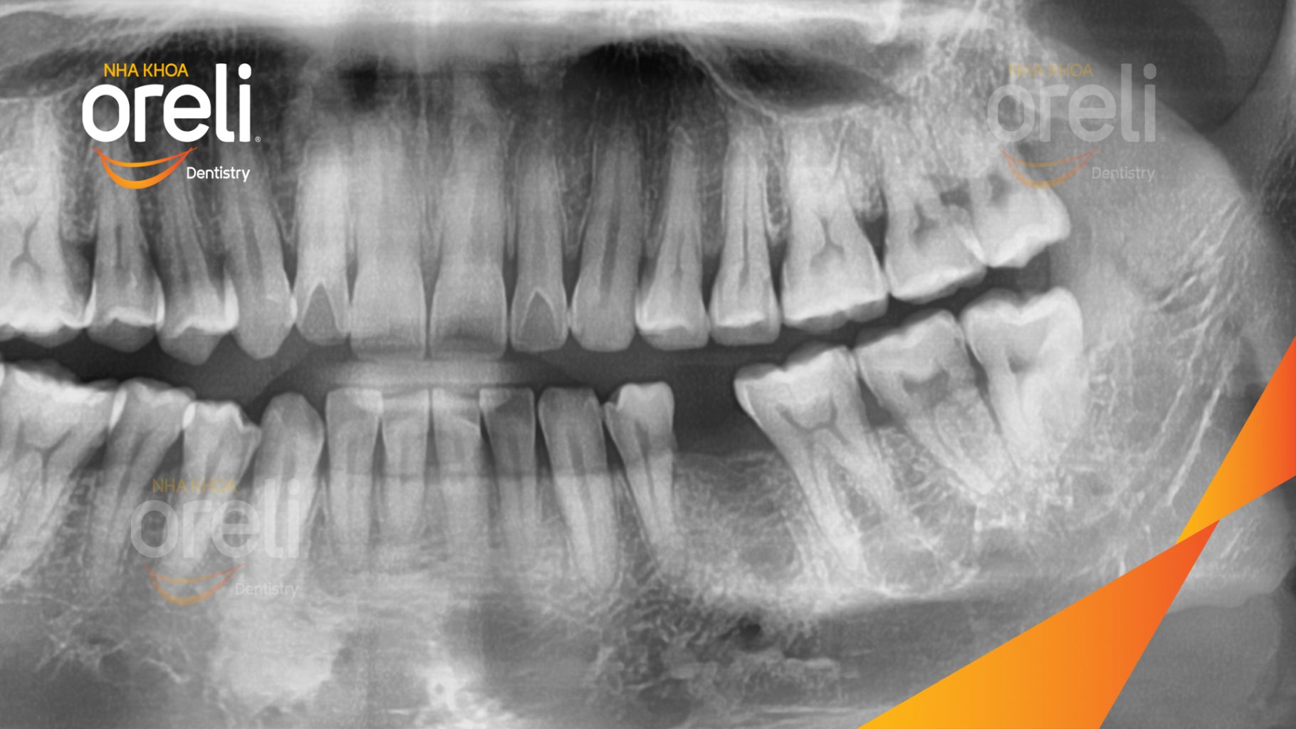 Trước điều trị: Mất răng hàm dưới tại Oreli