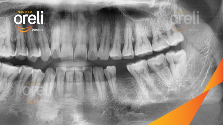 Ca Cấy Ghép Implant Phục Hồi Răng Tại Nha Khoa Oreli
