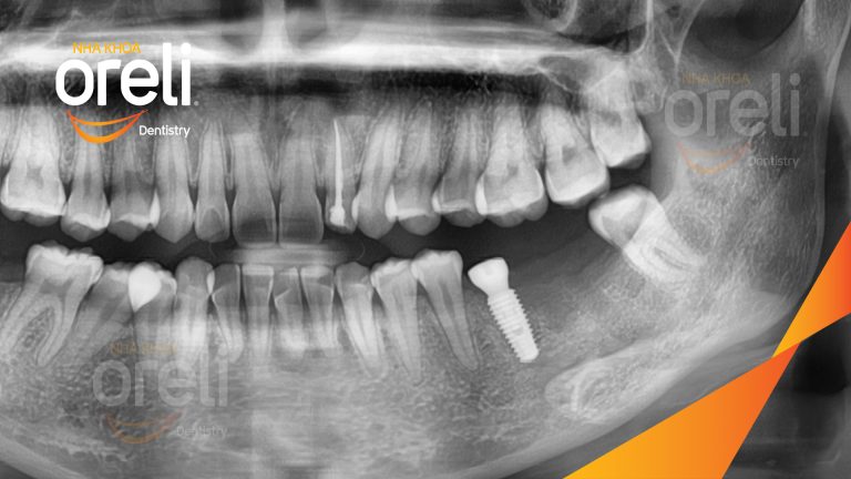 Ca Cấy Ghép Implant Hàm Dưới – Case thực tế tại Oreli