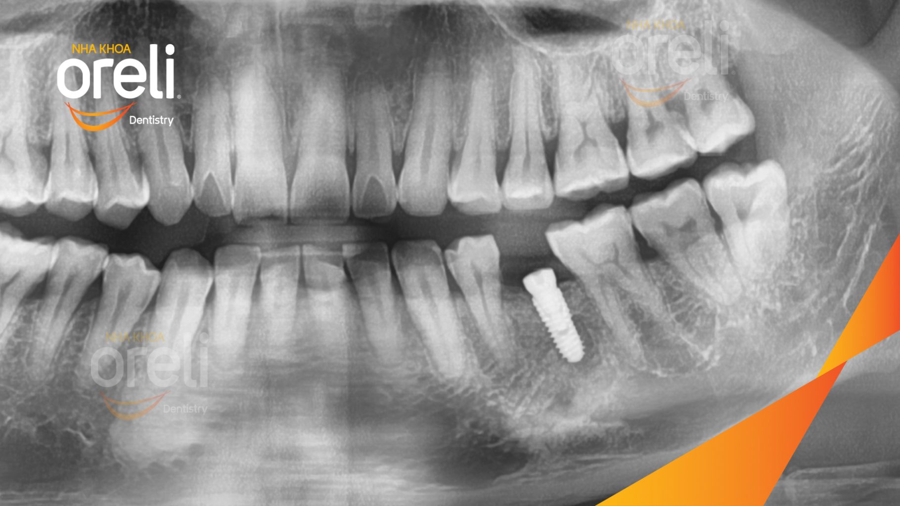 Mất răng hàm dưới trước khi điều trị tại Oreli