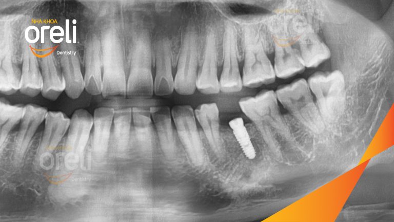 Ca Cấy Ghép Implant Phục Hồi Răng Tại Nha Khoa Oreli