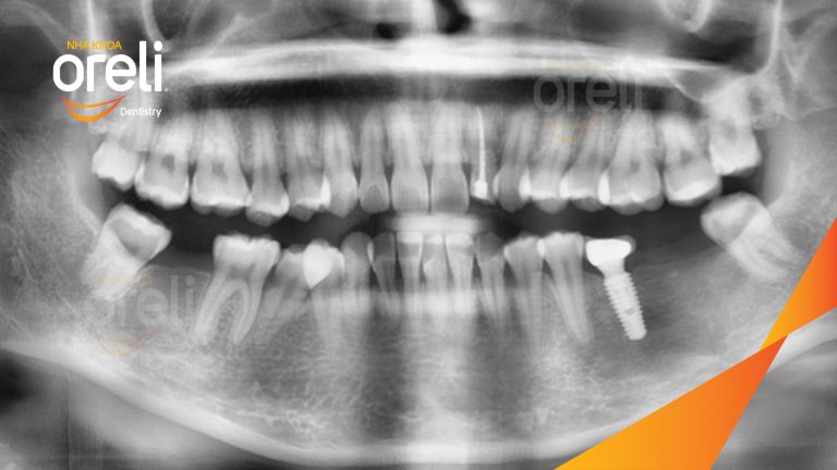 Ca Cấy Ghép Implant Phục Hồi Răng Tại Nha Khoa Oreli