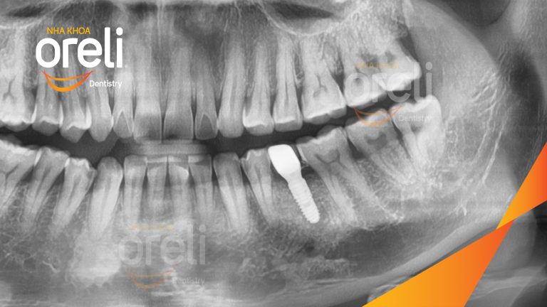 Ca Cấy Ghép Implant Phục Hồi Răng Tại Nha Khoa Oreli
