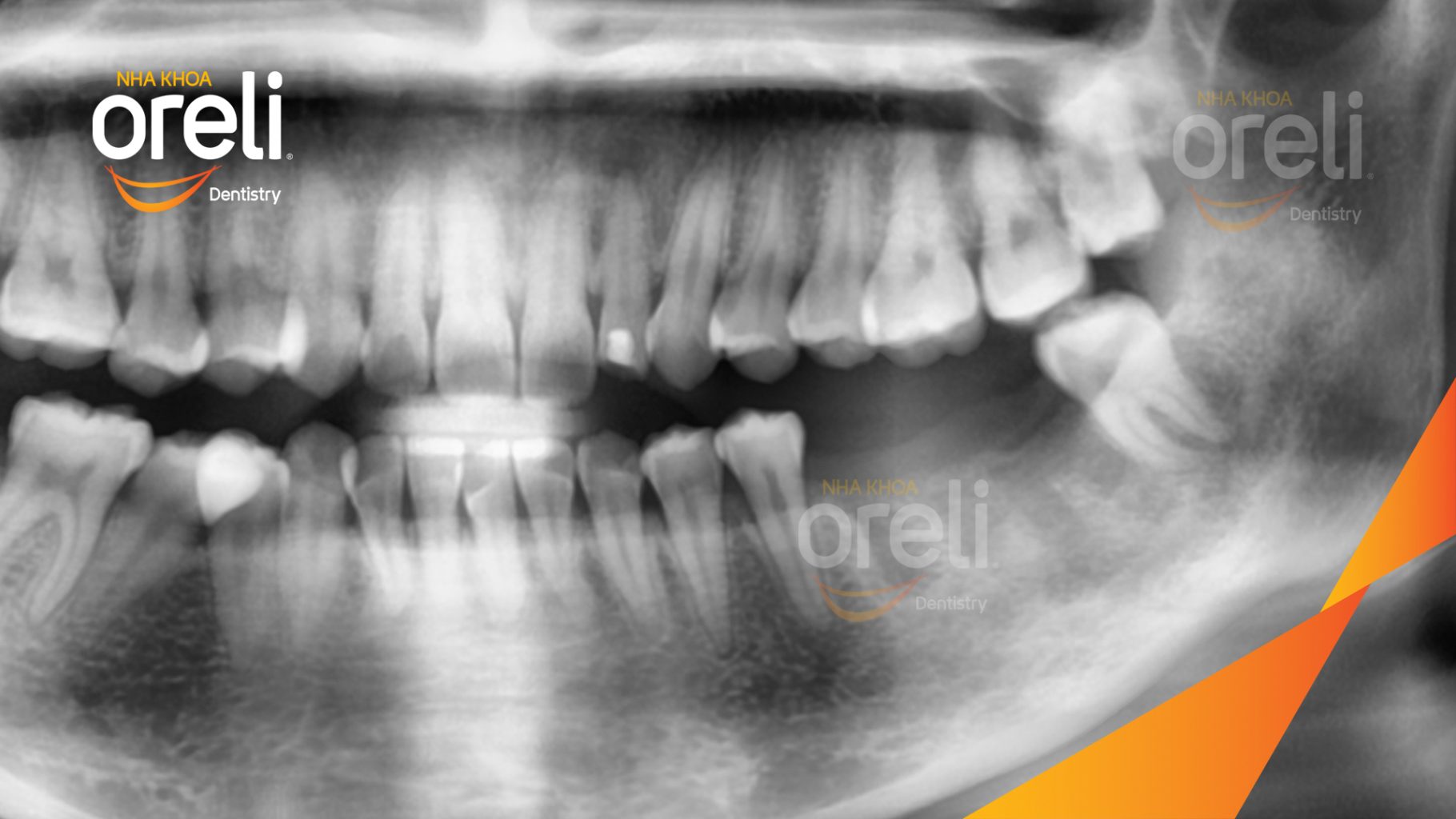Trước điều trị: Mất răng hàm dưới tại Oreli
