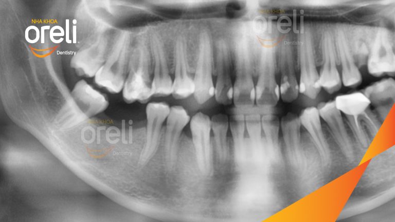 Ca Cấy Ghép Implant Hàm Dưới – Case thực tế tại Oreli