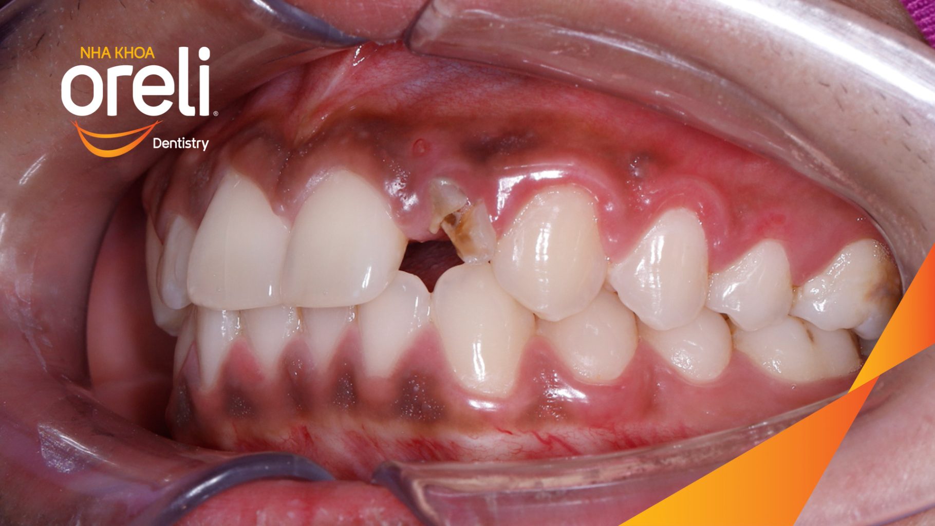Quá trình Cấy ghép trụ Implant chính hãng vào vùng mất răng trong 3 tháng tại Oreli