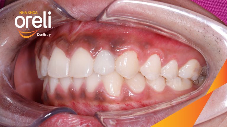 Ca Cấy Ghép Implant Hàm Trên – Case thực tế tại Oreli