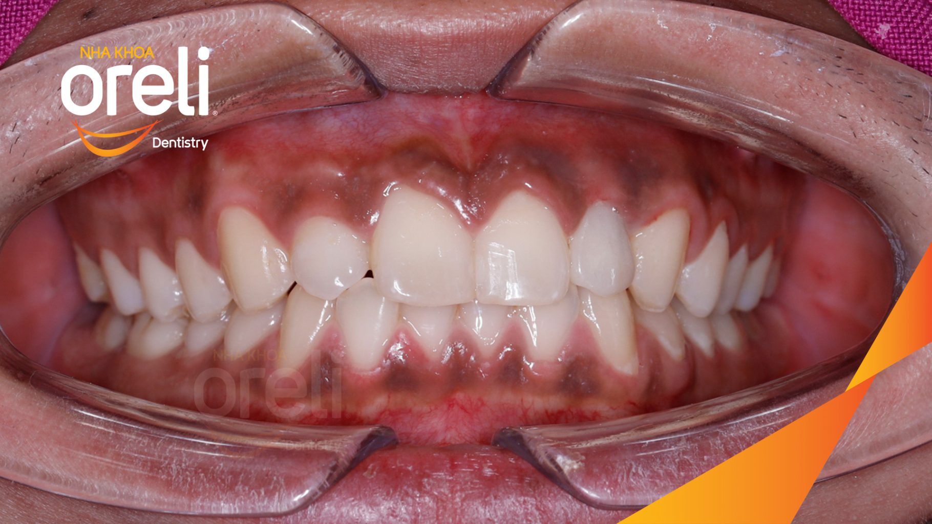 Quá trình Cấy ghép trụ Implant chính hãng vào vùng mất răng trong 3 tháng tại Oreli