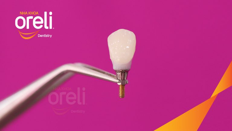 Ca Cấy Ghép Implant Hàm Trên – Case thực tế tại Oreli