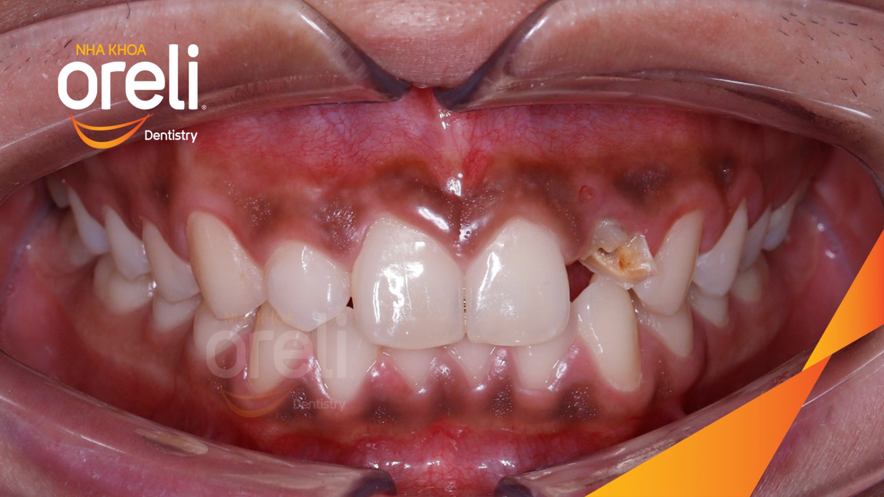Thực hiện Cấy ghép trụ Implant chính hãng vào vùng mất răng kéo dài 3 tháng tại Oreli