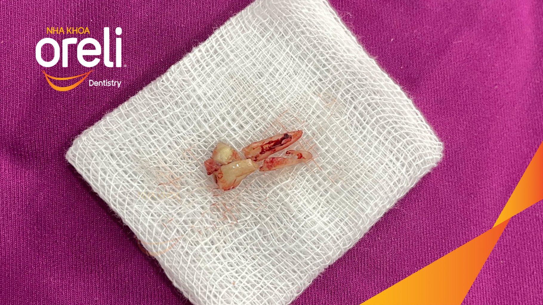 Kết quả sau 3 tháng: Phục hồi răng mất - ăn nhai chắc chắn và cười nói tự tin tại Oreli