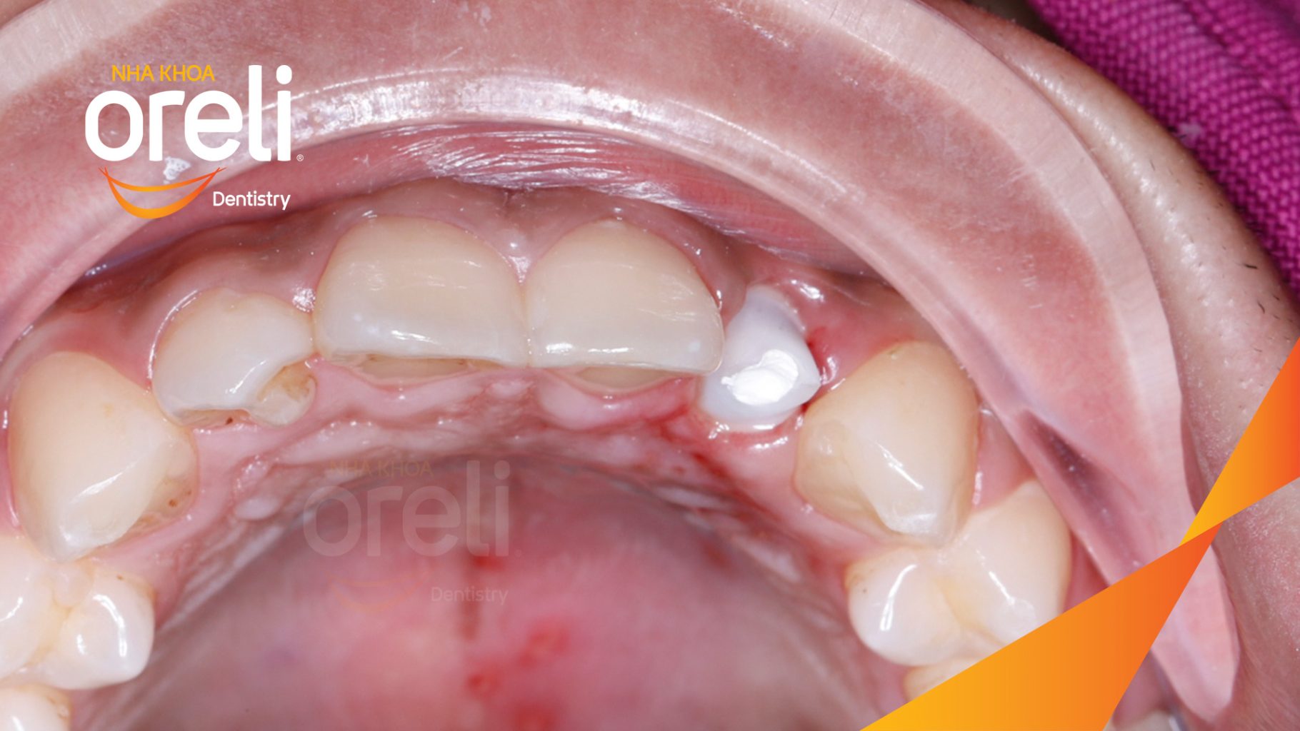 Kết quả đạt được sau 3 tháng - Phục hồi răng mất - ăn nhai chắc chắn và cười nói tự tin tại Oreli