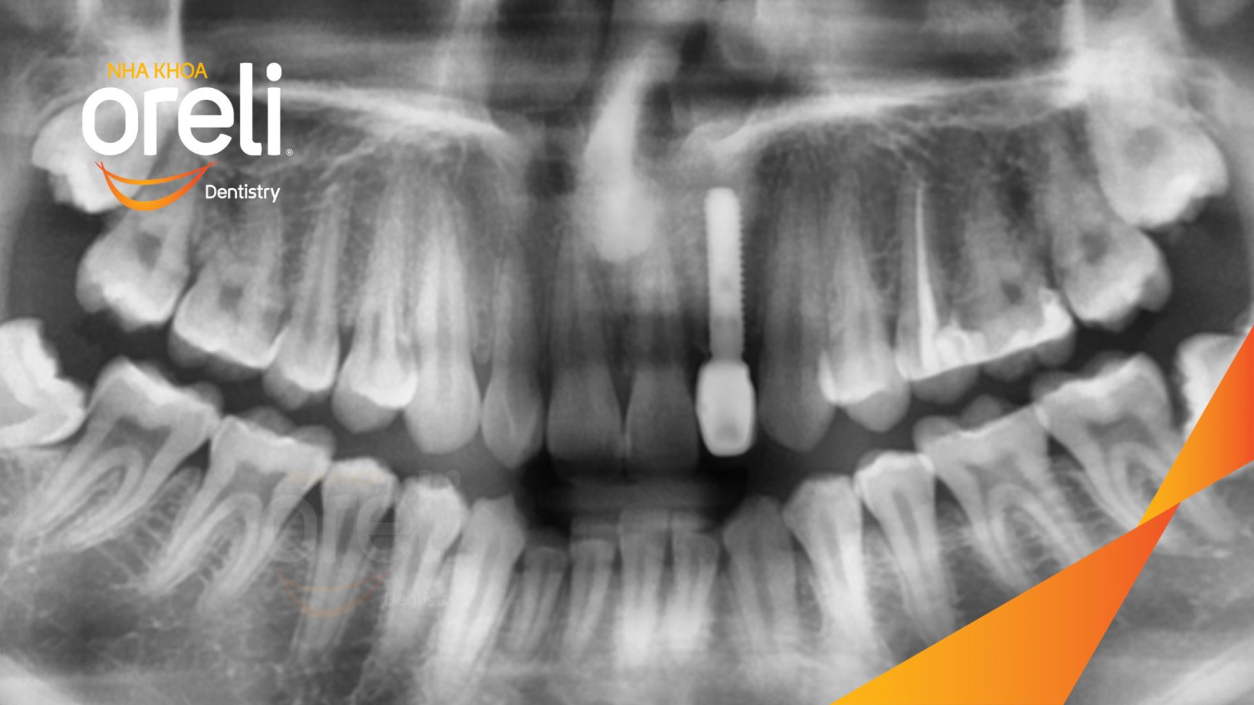 Mất răng hàm trên trước khi điều trị tại Oreli