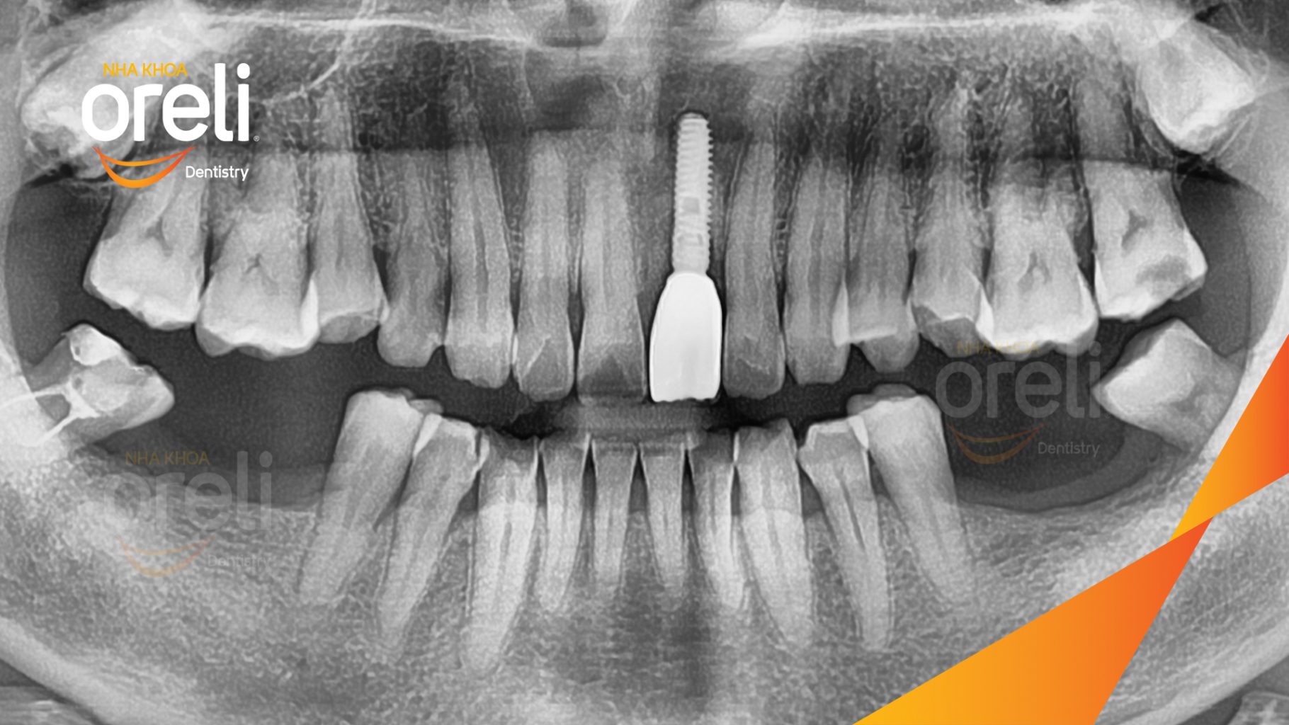 Mất răng cửa trước khi điều trị tại Oreli