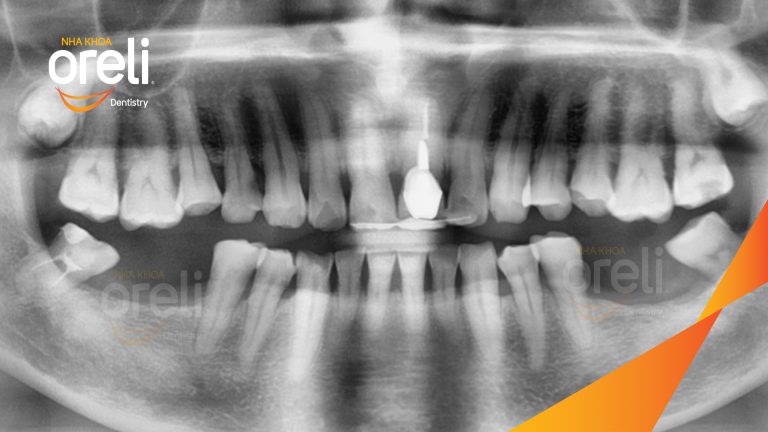 Ca Cấy Ghép Implant Phục Hồi Răng Cửa Tại Nha Khoa Oreli