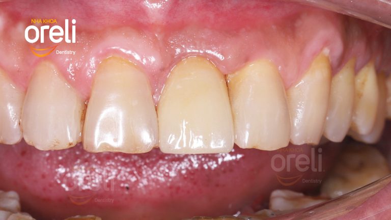 Ca Cấy Ghép Implant Phục Hồi Răng Cửa Tại Nha Khoa Oreli