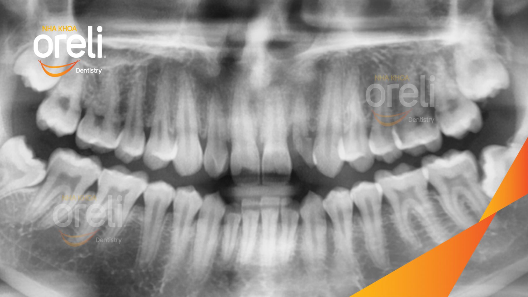 Trước điều trị: Mất răng hàm trên tại Oreli