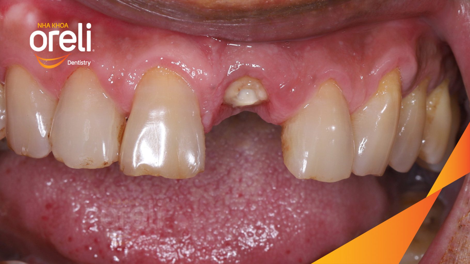 Quá trình Cấy ghép trụ Implant chính hãng vào vùng mất răng trong 3 tháng tại Oreli