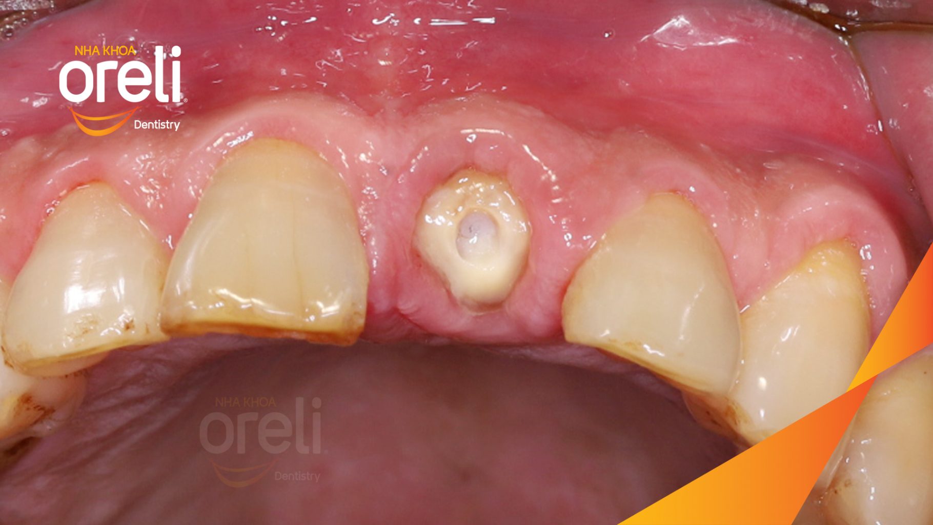 Thực hiện Cấy ghép trụ Implant chính hãng vào vùng mất răng kéo dài 3 tháng tại Oreli