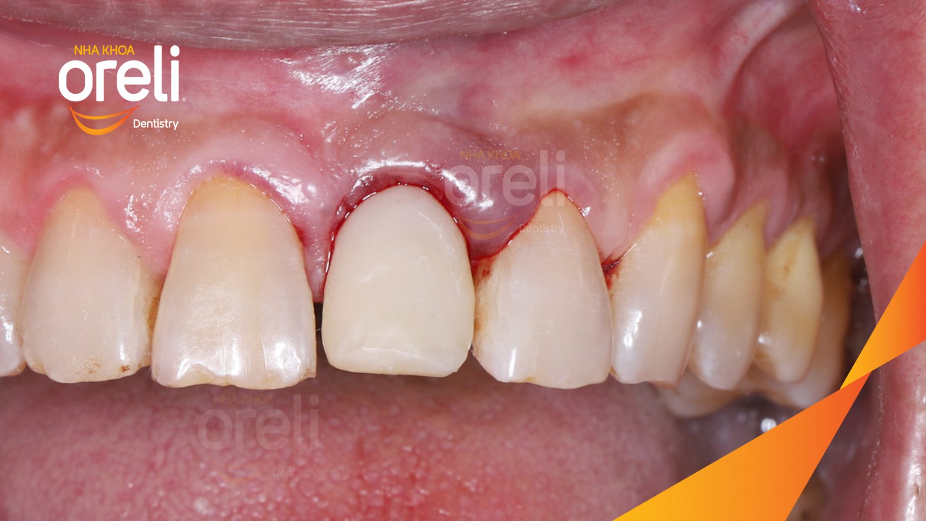 Kết quả sau 3 tháng: Phục hồi răng mất - ăn nhai chắc chắn và cười nói tự tin tại Oreli