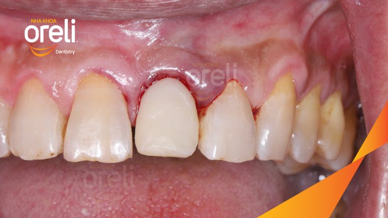 Ca Cấy Ghép Implant Phục Hồi Răng Cửa Tại Nha Khoa Oreli