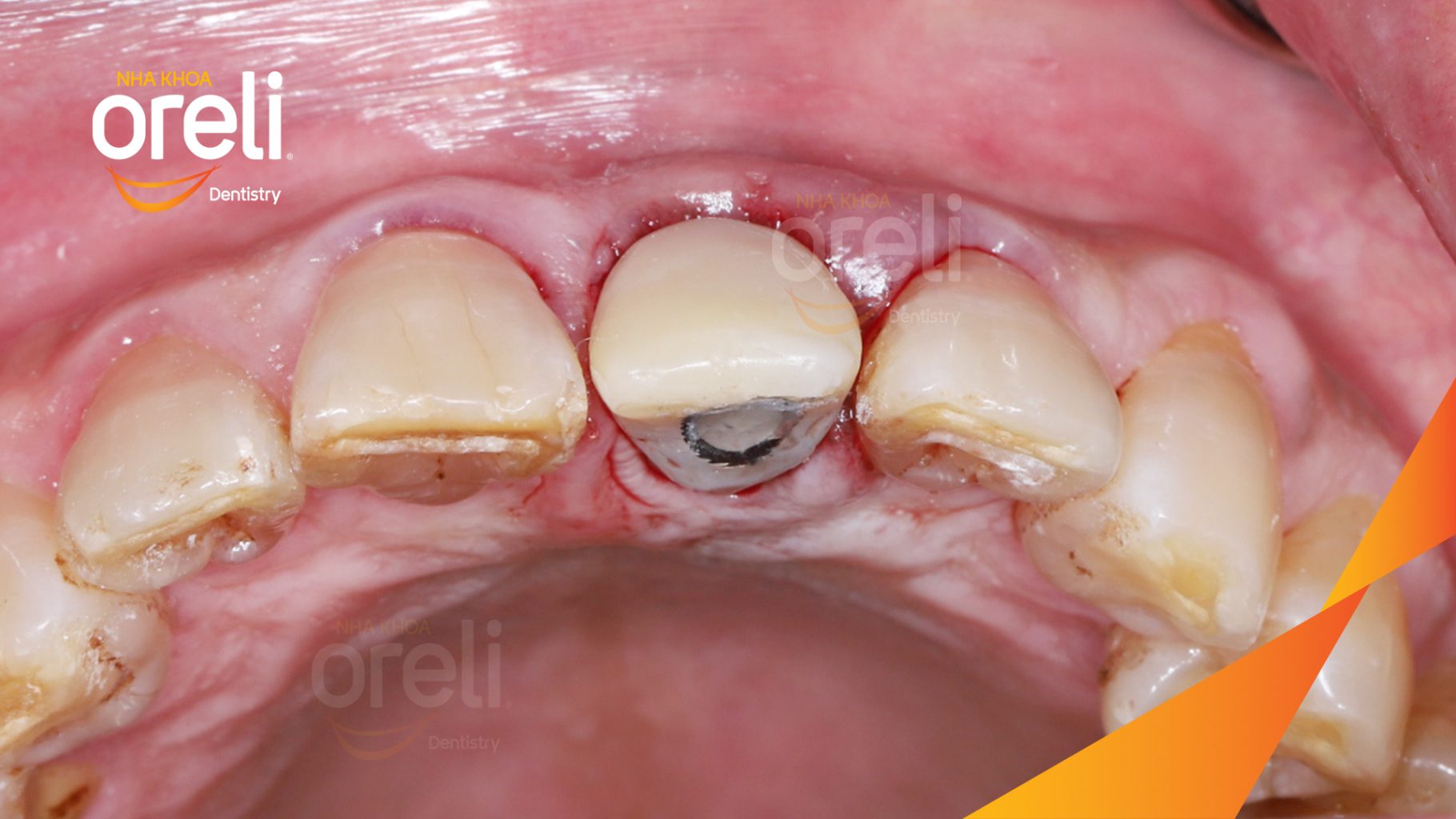 Kết quả đạt được sau 3 tháng - Phục hồi răng mất - ăn nhai chắc chắn và cười nói tự tin tại Oreli