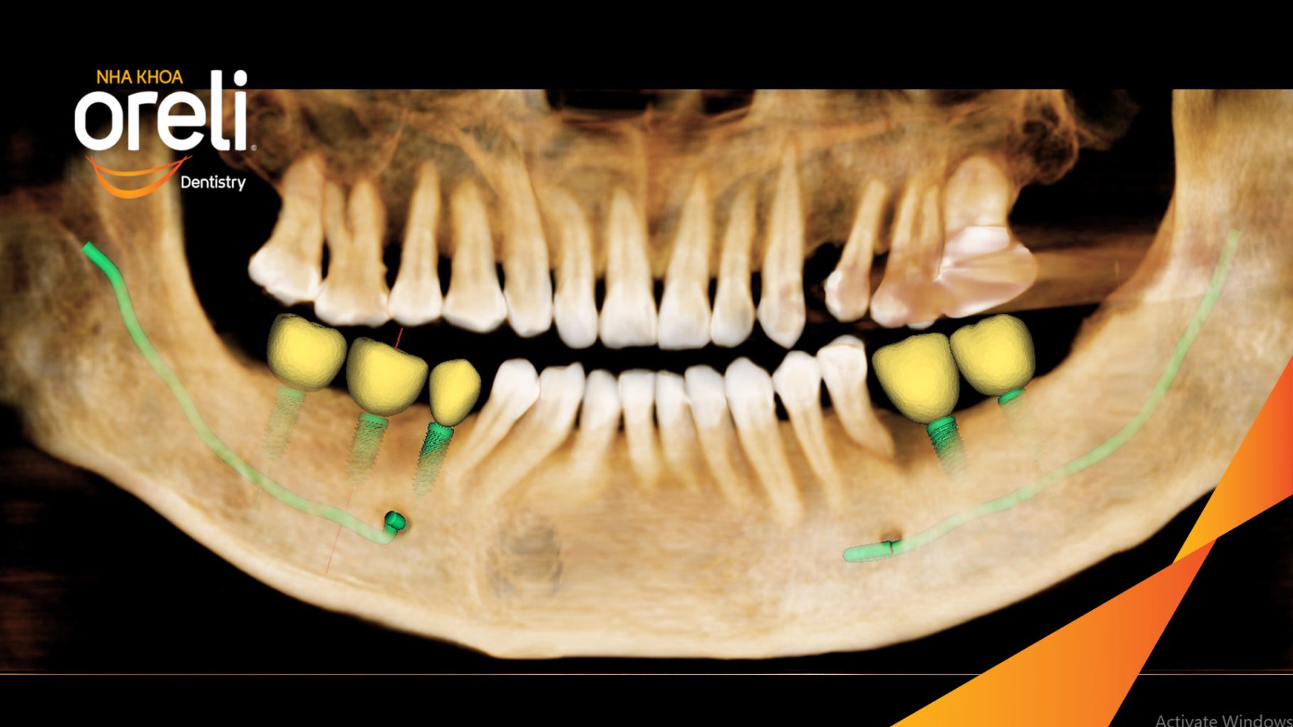 Thực hiện Cấy ghép trụ Implant chính hãng vào vùng mất răng kéo dài 3 tháng tại Oreli