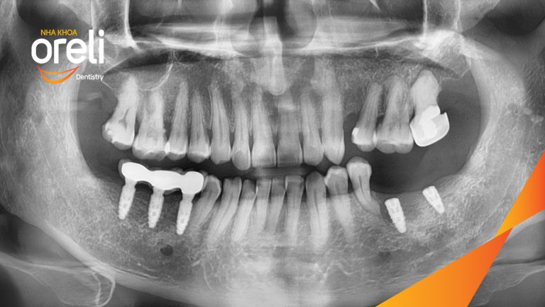 Ca Cấy Ghép Implant Phục Hồi Răng Tại Nha Khoa Oreli