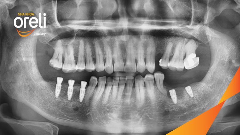 Ca Cấy Ghép Implant Phục Hồi Răng Tại Nha Khoa Oreli