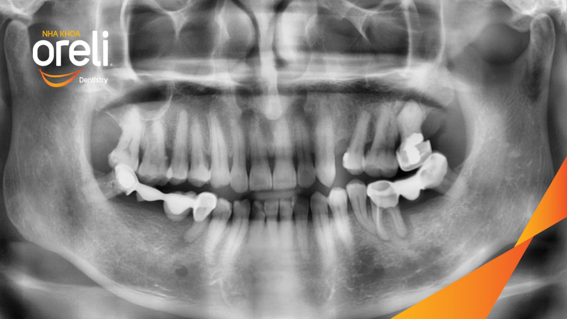 Trước điều trị: Mất răng hàm dưới tại Oreli