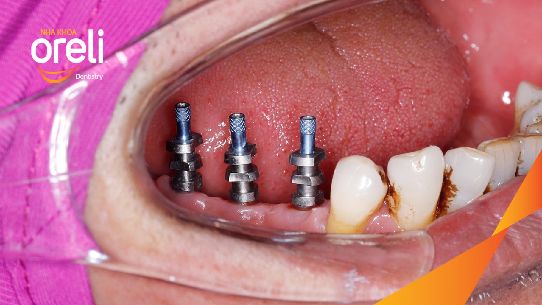 Trước điều trị: Mất răng hàm dưới tại Oreli